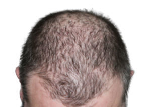 Hair thinning