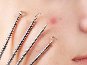 About Acne treatment and Scar removal